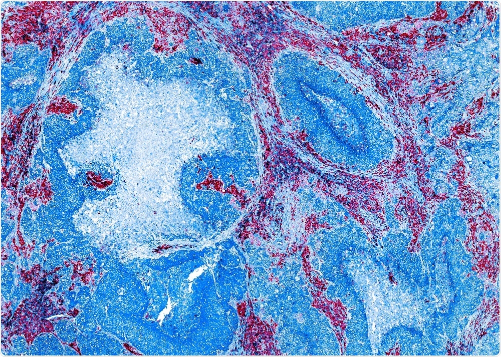Tissue section that has undergone multicolor IHC to generate a pink, blue and purple image - by Carl Dupont