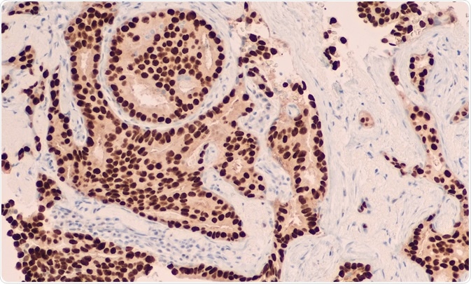 Breast cancer cells that have been visualized using immunohistochemistry (IHC) - photo taken By David Litman
