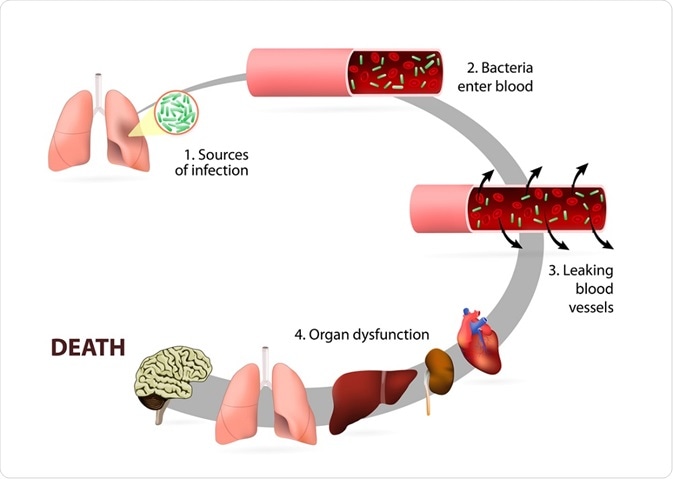 The stages of sepsis - a diagram - By Designua