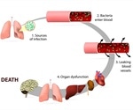 The Stages of Sepsis