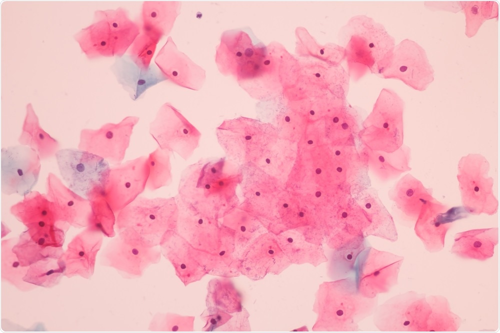 cervical cancer cells taken from pap smear test for cervical cancer - By Komsan Loonpro