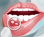 What is Stomatitis?