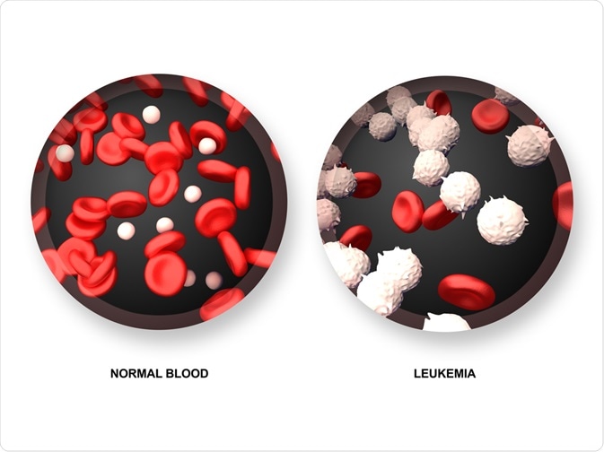 Healthy blood versus normal - By decade3d - anatomy online