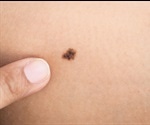 Visual inspection alone is insufficient to diagnose skin cancer