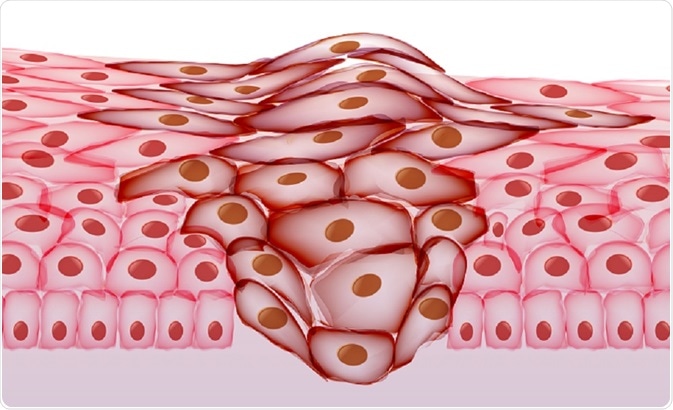 inbeve - cancer cells growing in epidermal tissue