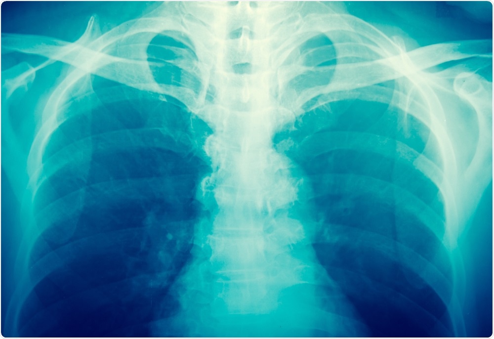 X-ray image - taken by toeytoey