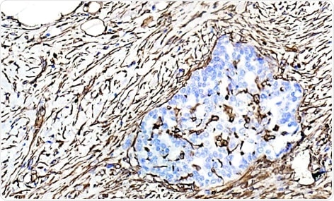 Vimentin recombinant rabbit monoclonal antibody (ab92547) staining in human ovarian cancer tissue using immunohistochemistry (formaldehyde-fixed, paraffin-embedded sections). Image courtesy of Mr Carl Hobbs, Kings College London.