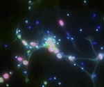 DNA “webs” shown to promote metastasis in ovarian cancer