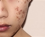 Acne could have a genetic basis find researchers promising new cure
