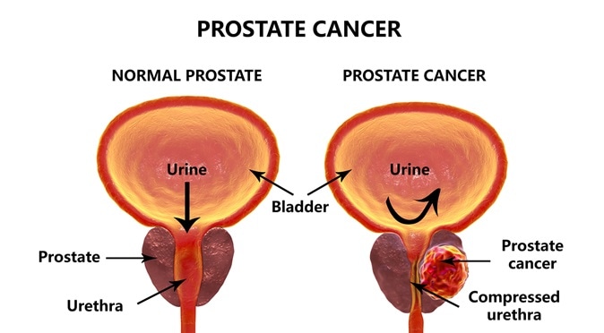 Prostate cancer, 3D illustration. Image Credit: Kateryna Kon / Shutterstock