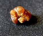 Kidney stones on the rise among Americans, finds study