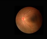 New discovery could help understand and treat glaucoma
