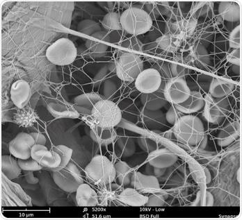 This is the example of a fibrin network with blood cells images with SEM.