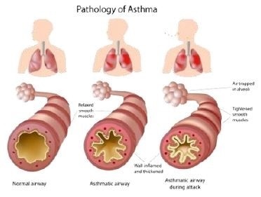 Pathology of asthma