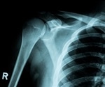 Encouraging Bone Defect Repair with Bioactive Glass