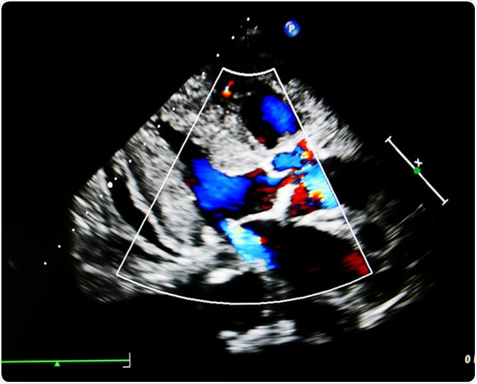 Flow color mode show jet from aortic and mitral valve regurgitation. Image Credit: Ling Stock / Shutterstock
