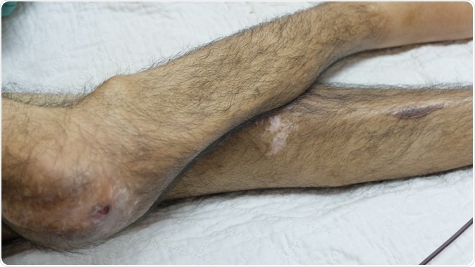 Lower limbs showing sign of muscle wasting. Image Credit: Casa nayafana / Shutterstock