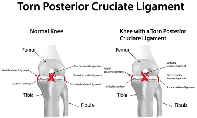 Torn Posterior Cruciate Ligament. Image Credit: joshya / Shutterstock
