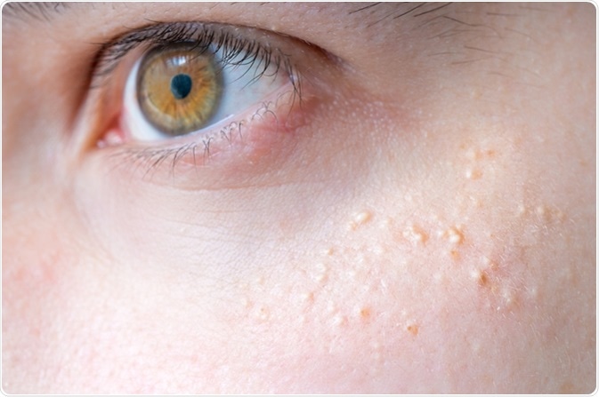 Milia (Milium) - pimples around eye on skin. Image Credit: vchal / Shutterstock