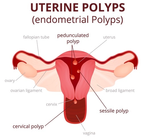 Classification of uterine polyps. Image Credit: Marochkina Anastasiia / Shutterstock