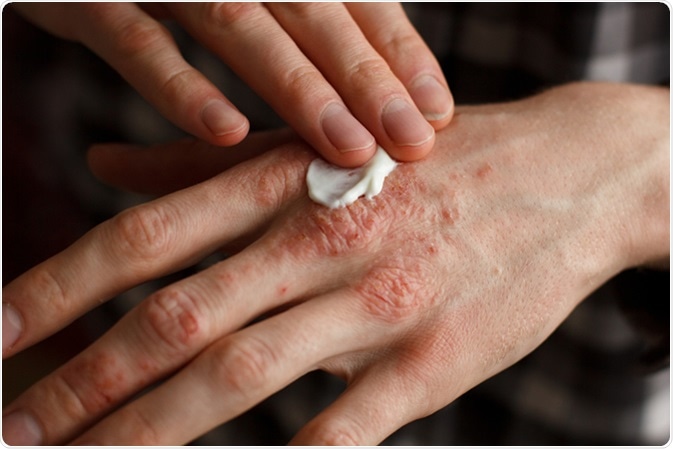 Eczema. Image Credit: Ternavskaia Olga Alibec / Shutterstock