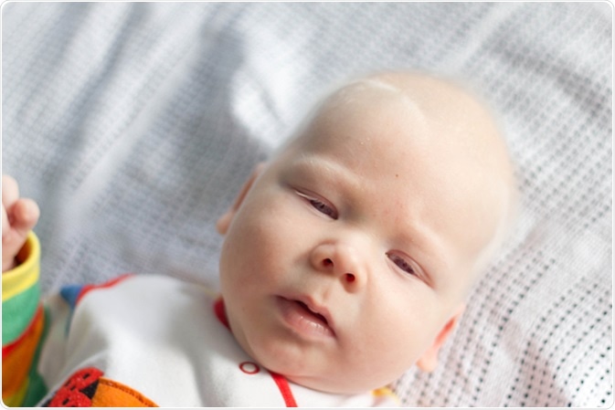 Baby boy with albinism syndrome. Image Credit: Iraidka . Shutterstock