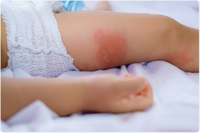 Leg of sleeping child with redness on the skin, suffering from food allergies. Image Credit: Yaoinlove / Shutterstock
