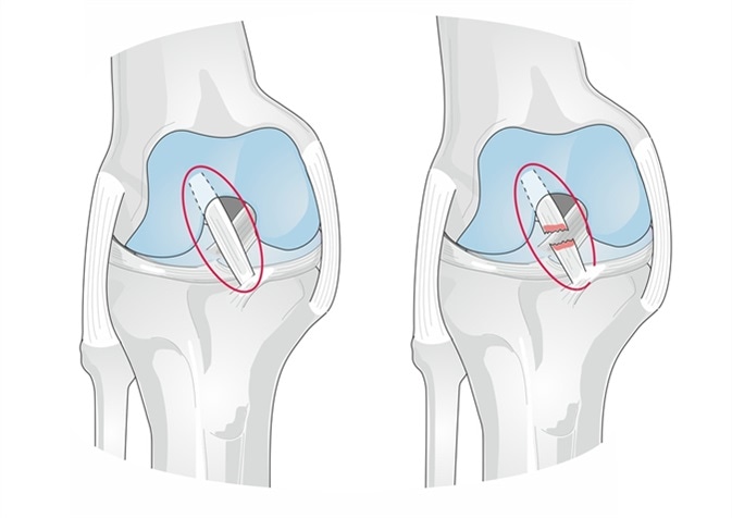 The anterior cruciate ligament (ACL) of the knee is injured usually during sports and activities. Image Credit: Soleil Nordic / Shutterstock