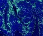 Researchers uncover how obesity leads to cancer in epithelial cells