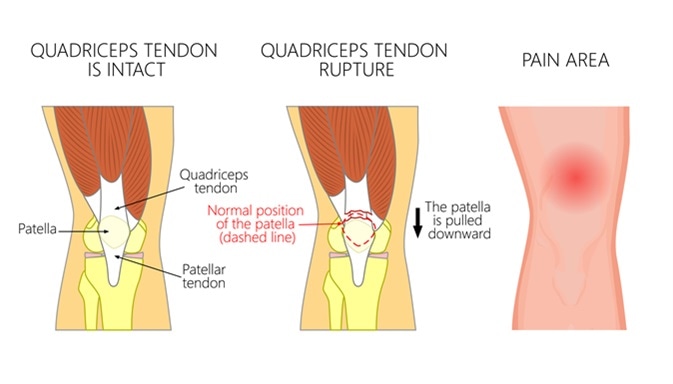 Quadriceps tendon rupture problem. Anatomy, front view of the human knee. Image Credit: Aksanaku / Shutterstock