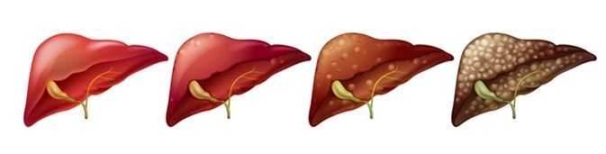 Different stages of human liver illustration. Image Credit: BlueRingMedia / Shutterstock