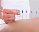 Acupuncture does not increase the chance of IVF success find researchers