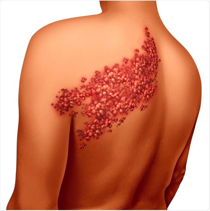 Shingles disease viral infection concept as a medical illustration with skin blisters hives and sores on a human back torso as a health symbol for a painful rash condition. Image Credit: Lightspring / Shutterstock
