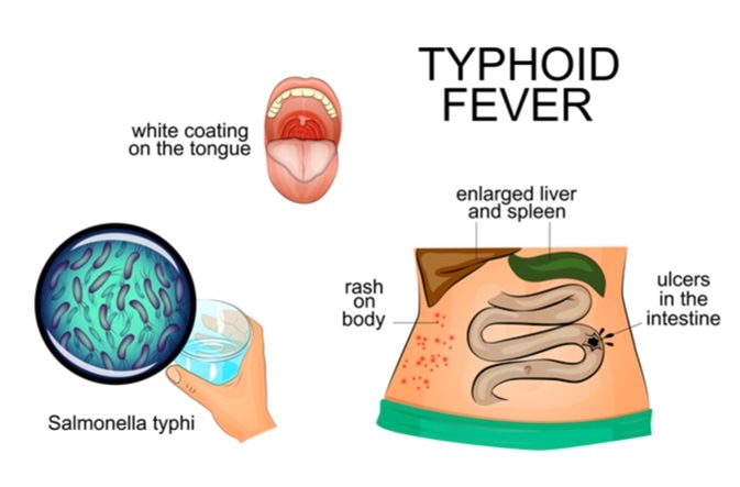 Illustration of typhoid fever. Image Credit: Artemida-psy / Shutterstock