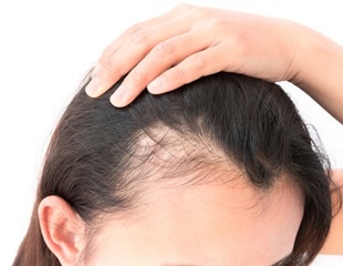 Baldness treatment using a medication for osteoporosis