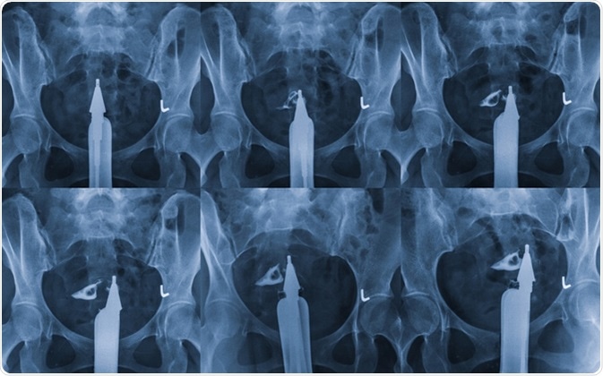 Hysterosalpingography is a type of X-ray called fluoroscopy that looks at a woman