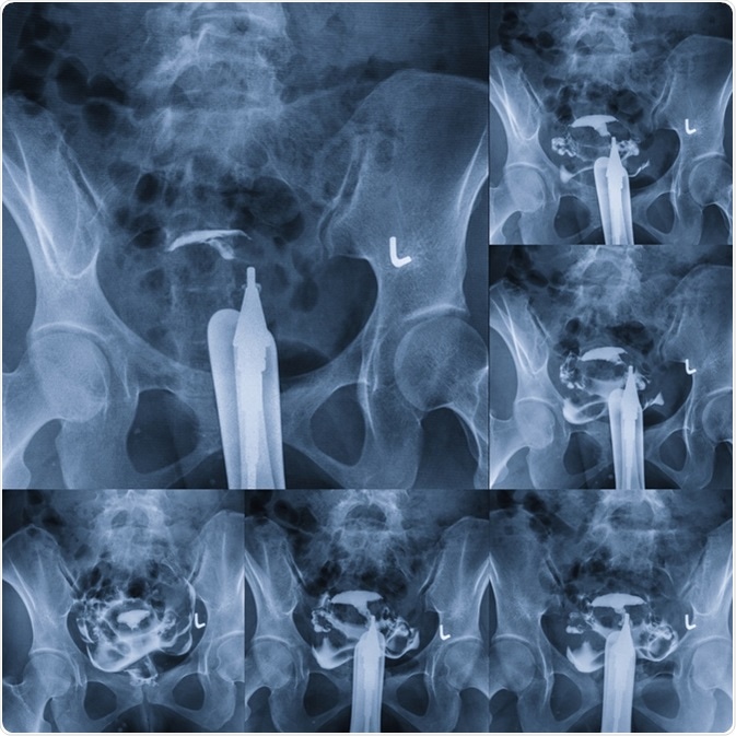 Hysterosalpingography - type of X-ray called fluoroscopy that looks at a woman
