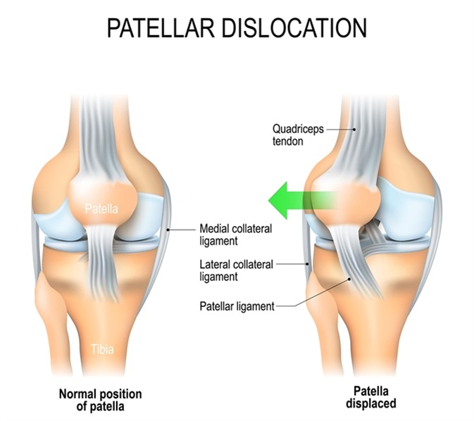 Patellar dislocation. Normal position of kneecap and Patella displaced. Anatomy of the Knee. Image Credit: Designua / Shutterstock