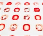 Whole genome sequencing could prevent transfusion reactions