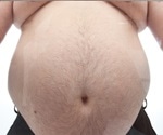 Abdominal Obesity and the Metabolic Syndrome