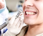 Tooth Polishing Procedure