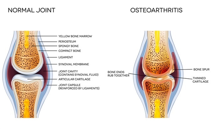 Osteoarthritis and normal joint anatomy. Image Credit: Tefi / Shutterstock
