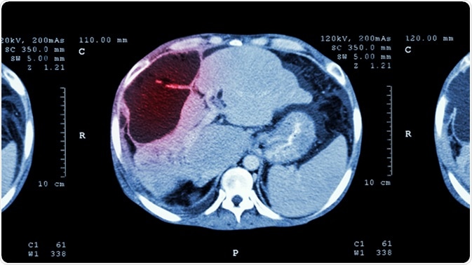 CT scan of upper abdomen : show abnormal mass at liver (Liver cancer). Image Credit: Puwadol Jaturawutthichai / Shutterstock