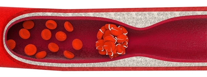 Thromboembolism, a blood clot. Image Credit: Anton Nalivayko / Shutterstock
