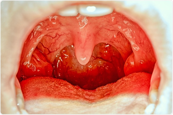 Open mouth showing tonsils. Image Credit: Elena11 / Shutterstock