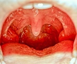 Tonsil removal as a child could mean chest infections risk as adults
