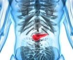 Late onset of diabetes could be indicative of pancreatic cancer