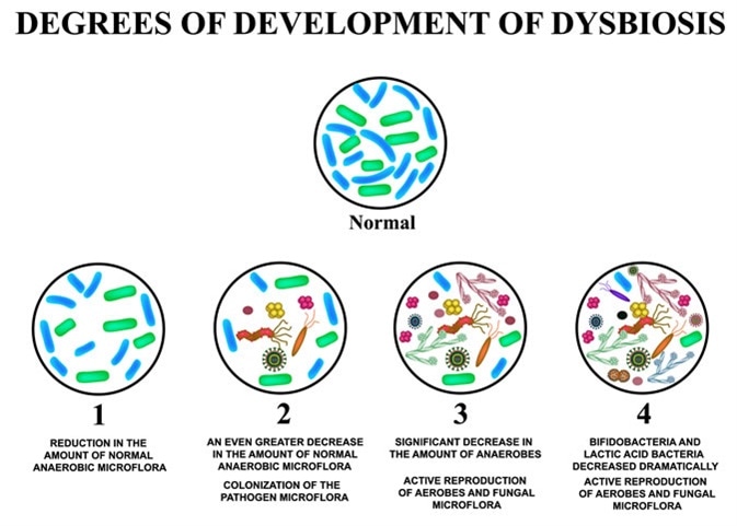 4 degrees of development of dysbiosis. Dysbacteriosis of the intestine. The large intestine. dysbiosis of colon. Image Credit: Timonina / Shutterstock