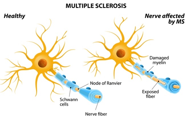 Multiple sclerosis or MS. autoimmune disease. the nerves of the brain and spinal cord are damaged by one