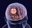 Head injuries may contribute to the development of glioma